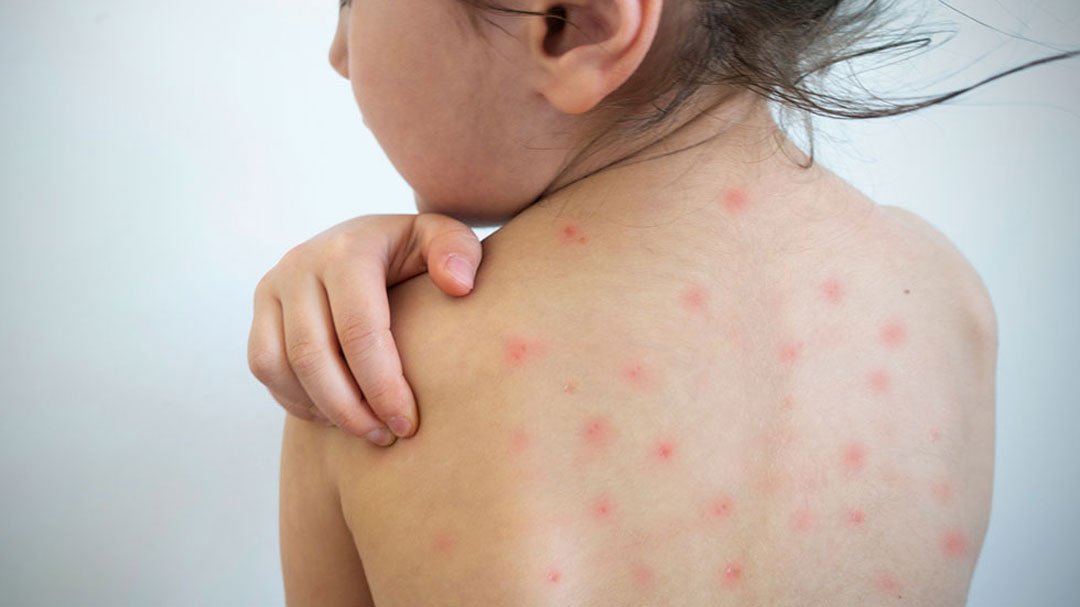 آزمایش Measles Virus Antibody چیست و چه کاربردهایی دارد؟