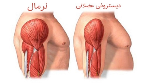 بیماری میوتونی مادرزادی